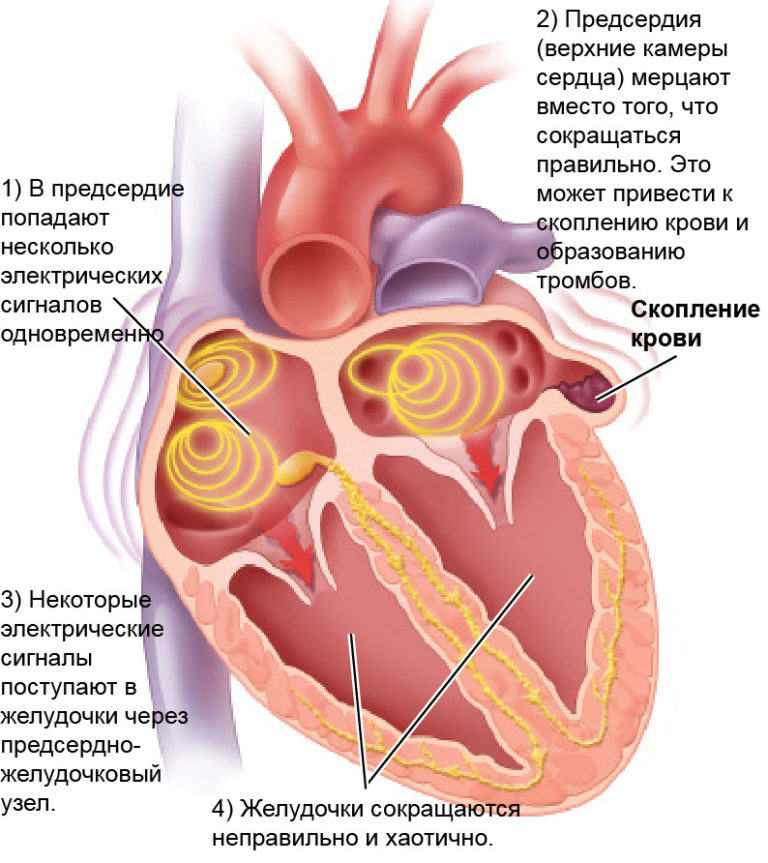 Мерцательная аритмия на фоне стресса