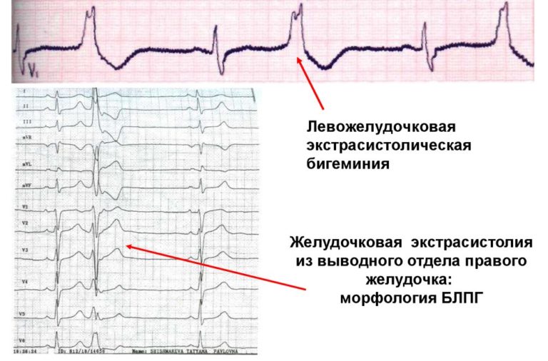 Желудочковая экстрасистолия на экг фото