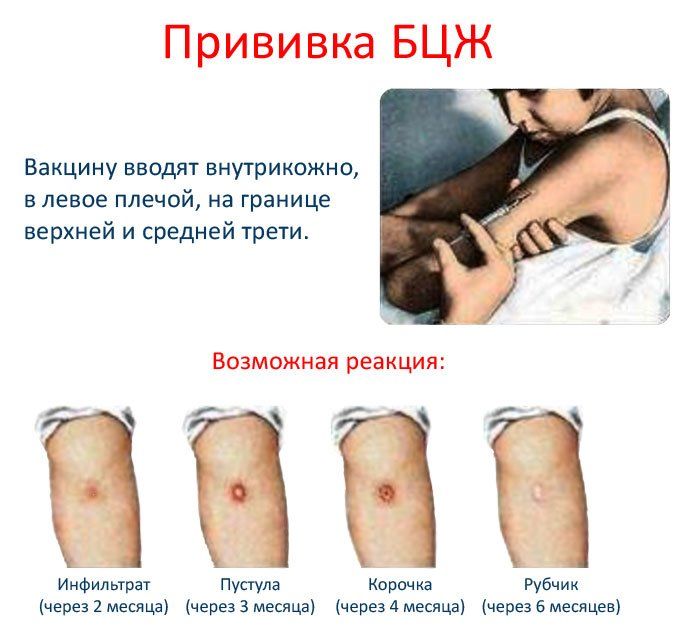 Схема прививок от туберкулеза