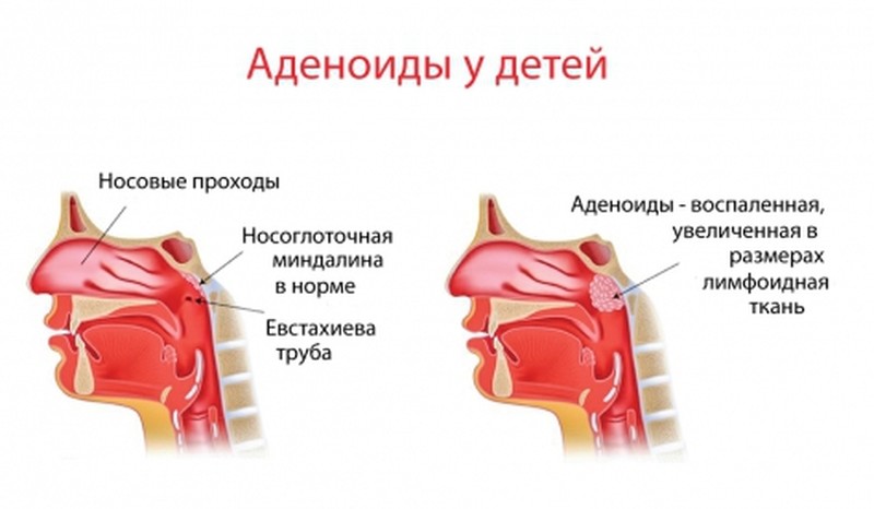Лимфомиозот от отека носа
